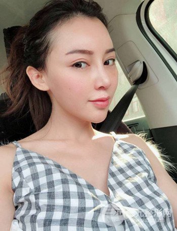 上海隆鼻失敗手術(shù)修復(fù)果超乎想象、前后對(duì)比照片分享