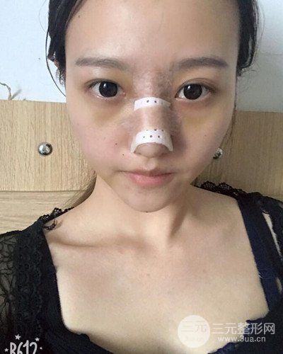 武漢美侖陳遠(yuǎn)海假體隆鼻案例，恢復(fù)過程分享~