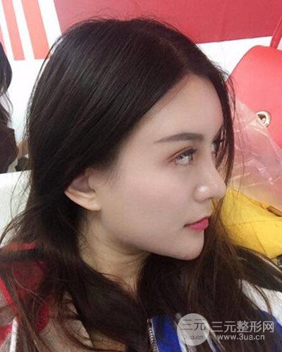 南京華美沈正宇假體隆鼻恢復(fù)過(guò)程前后對(duì)比圖分享~