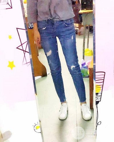 廣州韓妃大腿吸脂案例，恢復過程前后對比圖片分享~
