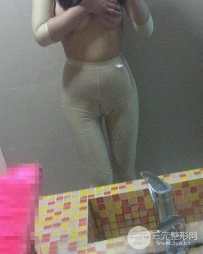 廣州韓妃大腿吸脂案例，恢復過程前后對比圖片分享~