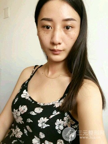 朱彤玥激光祛斑案例、兩個月果對比超明X