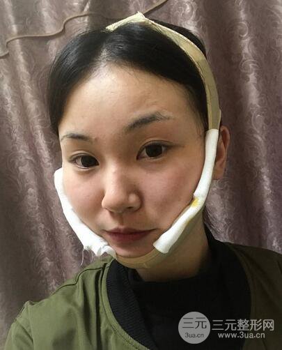 下頜角磨骨整形全過程分享，附上術(shù)后恢復(fù)照片~