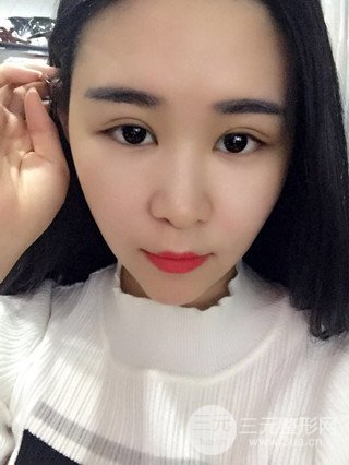 深圳全切雙眼皮修復成功案例恢復過程分享