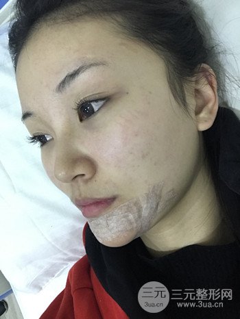 濟(jì)南硅膠假體墊下巴真人案例、下巴改變整個臉型