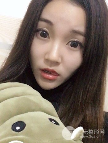 濟(jì)南硅膠假體墊下巴真人案例、下巴改變整個臉型