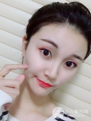 濟(jì)南硅膠假體墊下巴真人案例、下巴改變整個臉型