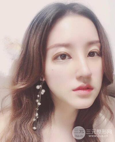 顧陸健做鼻子隆鼻案例術(shù)后恢復(fù)果分享