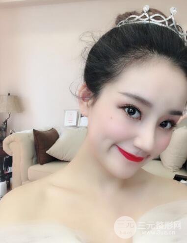 顧陸健做鼻子隆鼻案例術(shù)后恢復(fù)果分享