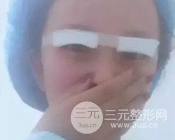 南京鼓樓譚謙醫(yī)生切開雙眼皮案例，恢復圖分享~