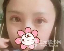 南京鼓樓譚謙醫(yī)生切開雙眼皮案例，恢復圖分享~