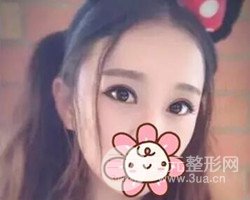 南京鼓樓譚謙醫(yī)生切開雙眼皮案例，恢復圖分享~