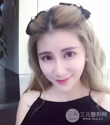 網(wǎng)絡(luò)主播做自體脂肪豐太陽(yáng)穴真實(shí)案例分享，果杠杠的