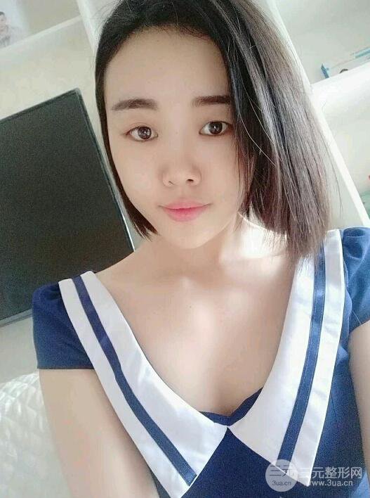 成都軍大鐘正強(qiáng)自體脂肪填充面部案例恢復(fù)圖，馬上變成“初戀臉”