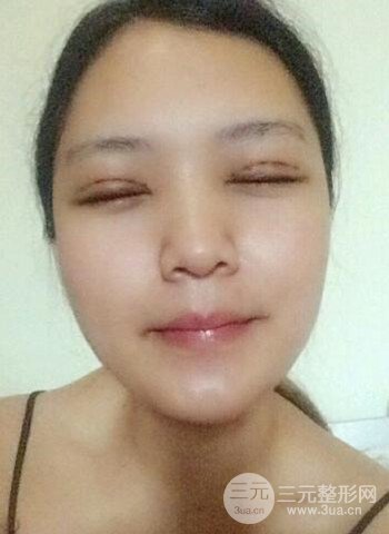 深圳雙眼皮正就內(nèi)雙小眼睛，真實案例前后對比照片