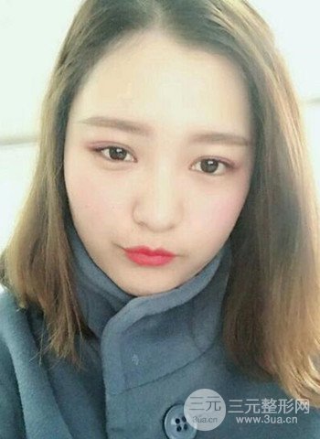 深圳雙眼皮正就內(nèi)雙小眼睛，真實案例前后對比照片