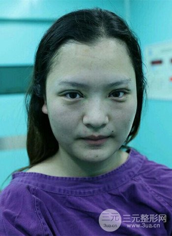 深圳雙眼皮正就內(nèi)雙小眼睛，真實案例前后對比照片