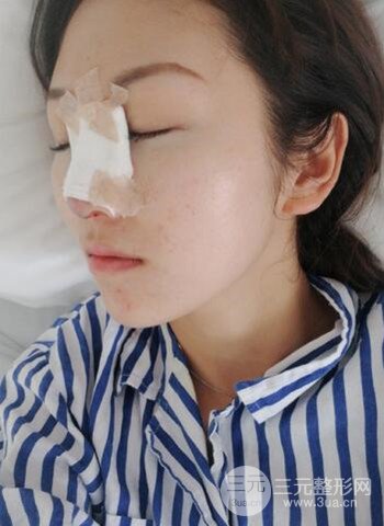 廣州隆鼻整形真實(shí)恢復(fù)期圖片，擁有精致美鼻不是夢