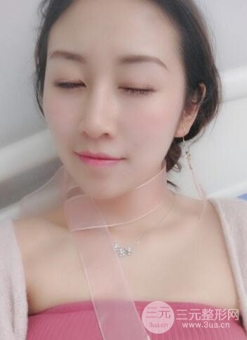 廣州隆鼻整形真實(shí)恢復(fù)期圖片，擁有精致美鼻不是夢