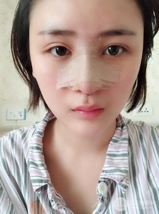 重慶五洲范文亮隆鼻整形案例，前后對比圖分享
