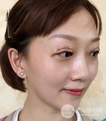 北京雙眼皮失敗修復(fù)手術(shù)日記分享，附上前后對比照片