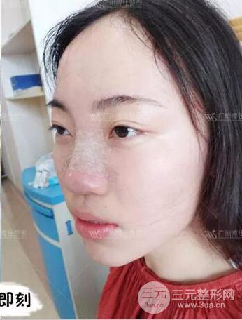 廣州博仕隆鼻失敗修復(fù)案例，前后恢復(fù)過程分享~