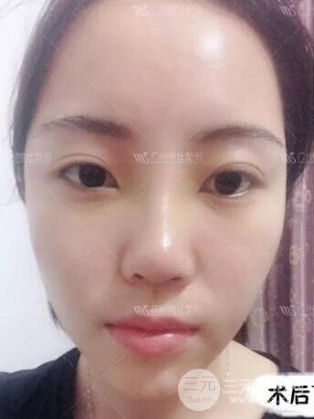 廣州博仕隆鼻失敗修復(fù)案例，前后恢復(fù)過程分享~