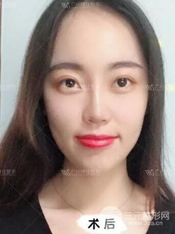 廣州博仕隆鼻失敗修復(fù)案例，前后恢復(fù)過程分享~