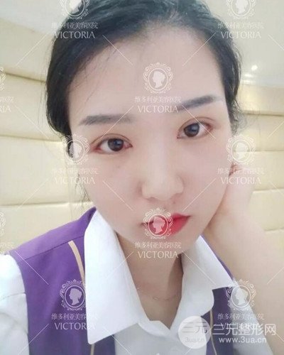 南京維多利亞切開雙眼皮+開眼角案例分享，附上前后對(duì)比圖
