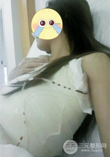 深圳假體隆胸讓平胸妹華麗變身，手術果分享