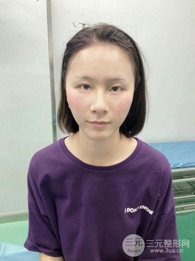 武漢伊美馨桂亮醫(yī)生自體脂肪填充面部前后對比圖恢復日記分享~