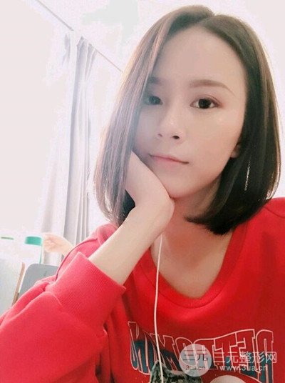 武漢伊美馨桂亮醫(yī)生自體脂肪填充面部前后對比圖恢復日記分享~
