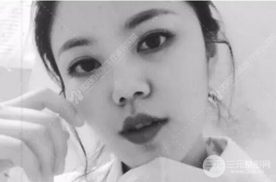 沈陽百嘉麗侯亞杰光纖溶脂瘦臉恢復(fù)日記