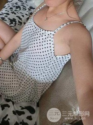 青島華韓趙煜楠假體隆胸日記恢復記錄分享~