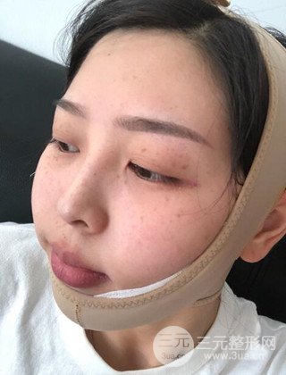 面部吸脂瘦臉手術日記分享，瘦臉果驚人
