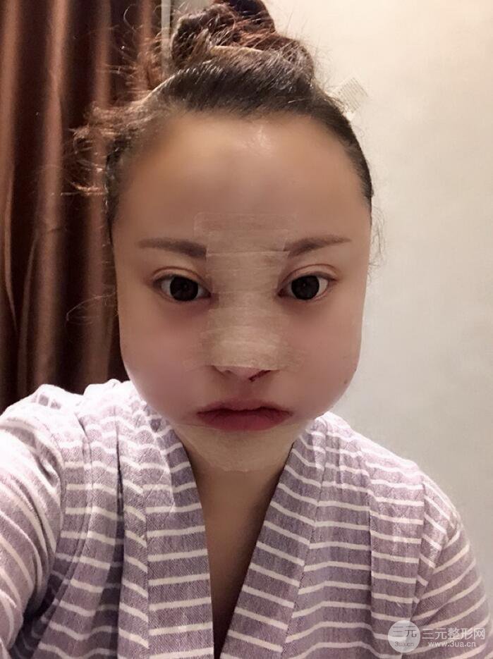 太原麗都面部吸脂+假體隆鼻案例分享，精致面部小V臉了解一下~