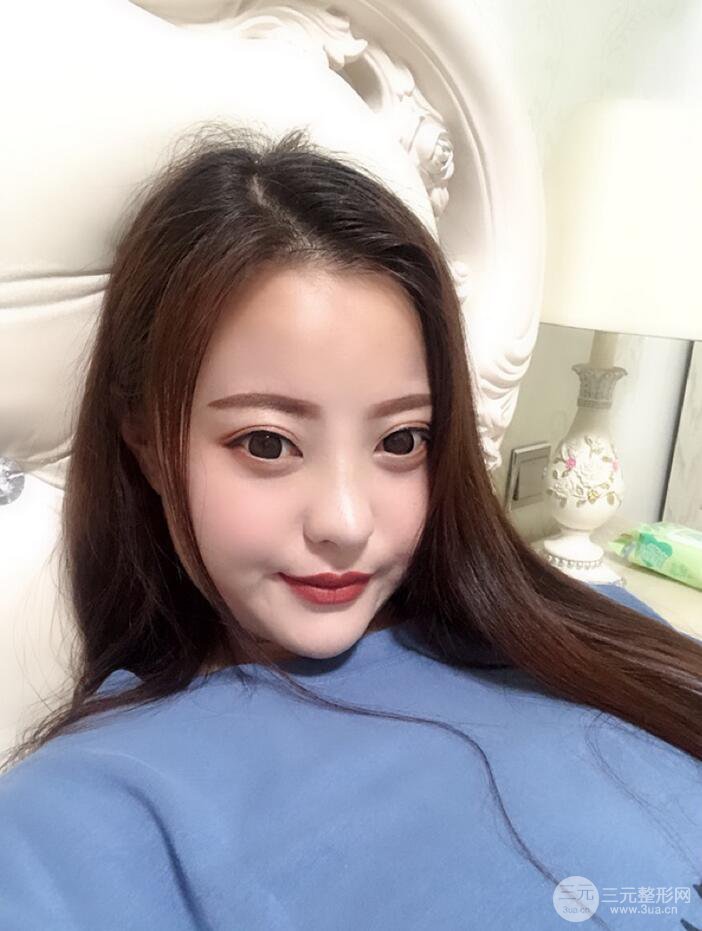 太原麗都面部吸脂+假體隆鼻案例分享，精致面部小V臉了解一下~