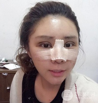 隆鼻整形+埋埋蛋白線.提升+自體脂肪全臉填充術(shù)后改頭換面！