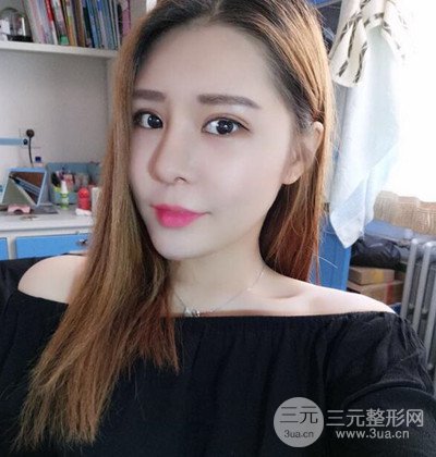 隆鼻整形+埋埋蛋白線.提升+自體脂肪全臉填充術(shù)后改頭換面！