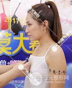 廣州曙光假體隆胸一個月恢復記錄分享