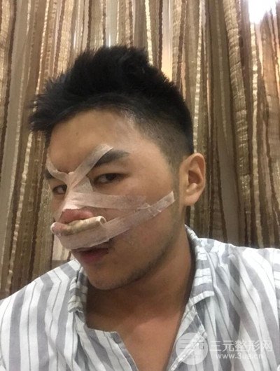 成都玉之光黃開亮醫(yī)生隆鼻修復(fù)整形案例，前后恢復(fù)過程分享