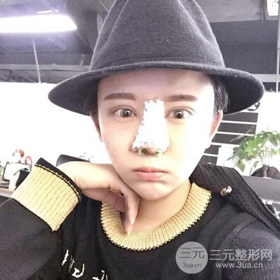 北京協(xié)和劉志飛隆鼻修復案例恢復過程日記分享