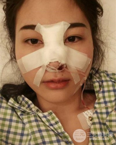 膨體隆鼻案例分享，四川華人醫(yī)療游曉波醫(yī)生做的!