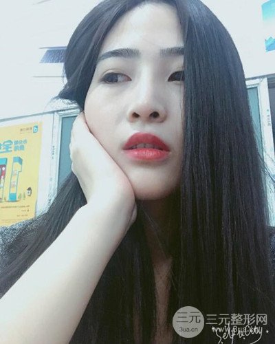 膨體隆鼻案例分享，四川華人醫(yī)療游曉波醫(yī)生做的!