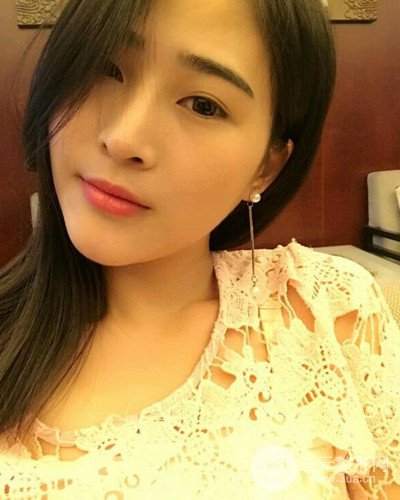 膨體隆鼻案例分享，四川華人醫(yī)療游曉波醫(yī)生做的!