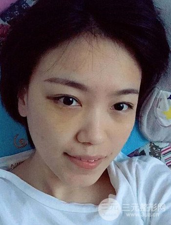 北京內(nèi)切祛眼袋真人案例果對比分享，年輕十歲不是夢