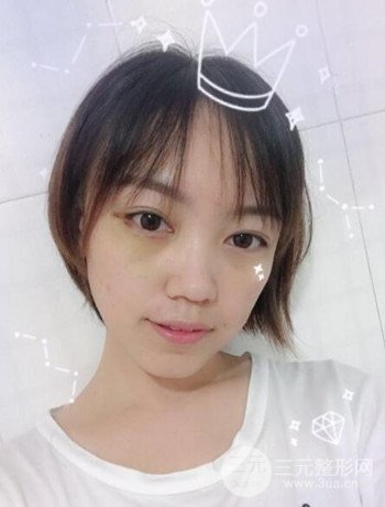 北京內(nèi)切祛眼袋真人案例果對比分享，年輕十歲不是夢