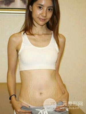 北京301醫(yī)院激光去妊娠紋案例恢復圖片分享