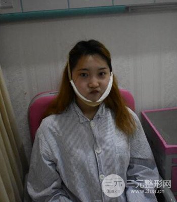 終于做了下頜角整形，分享術(shù)后恢復(fù)果