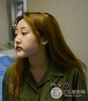 終于做了下頜角整形，分享術(shù)后恢復(fù)果